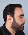 After Hair Transplant&nbsp;2 Sessions (Areas)